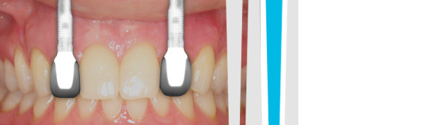 Dental implants before crown placement