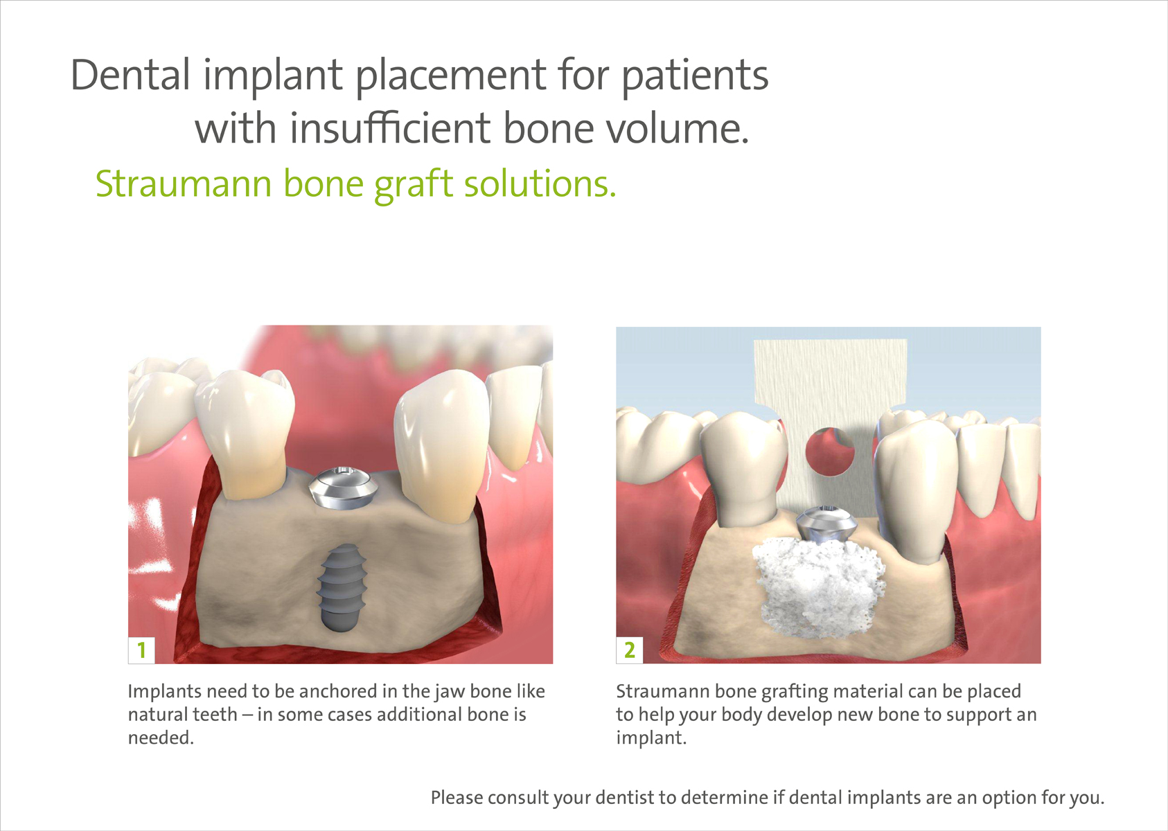 Dental implant placement for insufficient bone volume