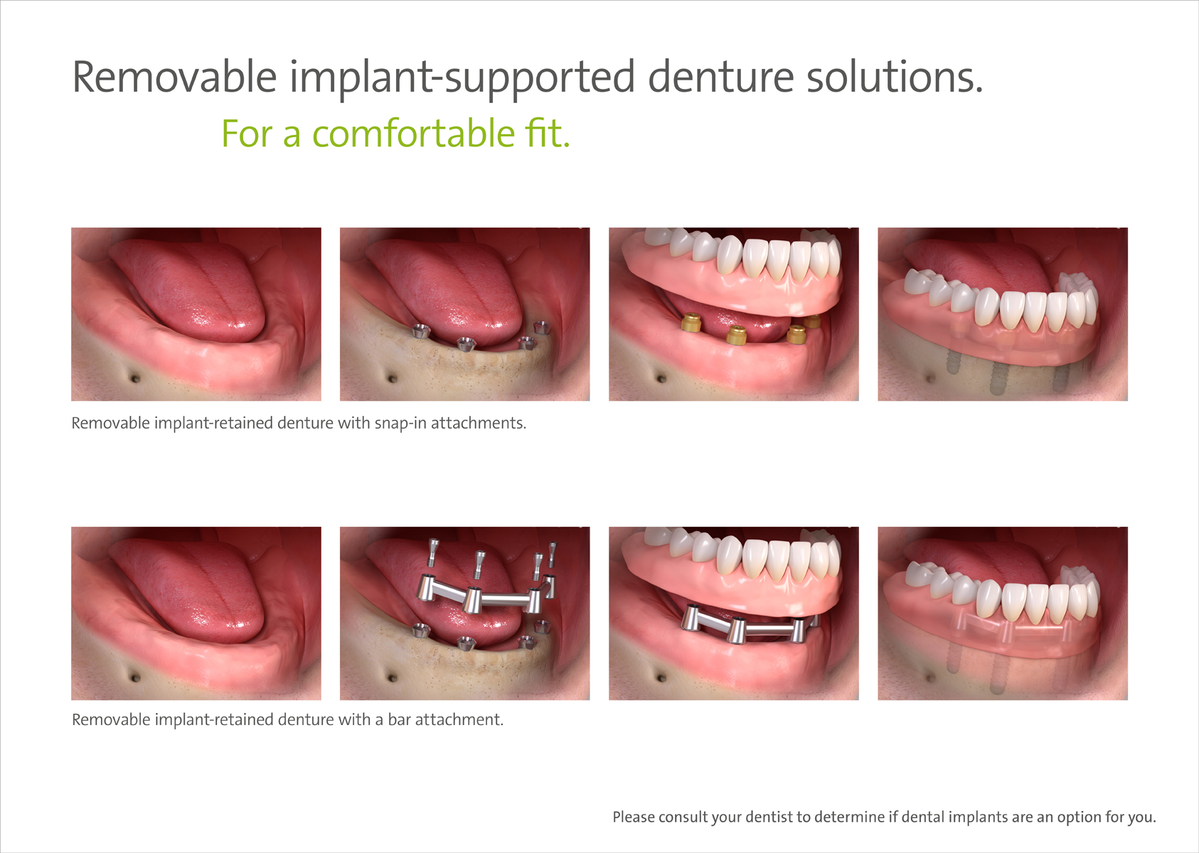 Removable Implant Supported Denture