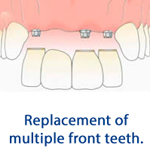 Replacement of multiple front teeth
