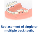 Replacement of single or multiple back teeth