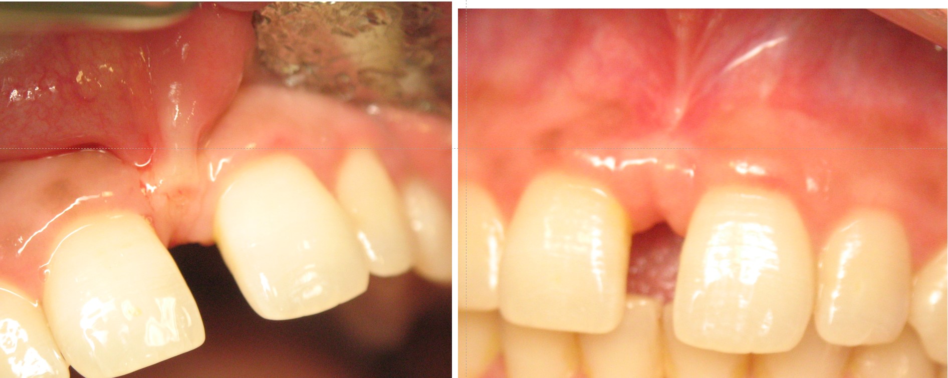 Frenectomy before and after